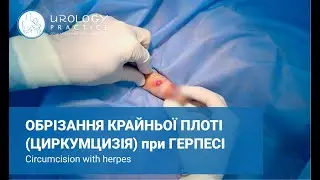 Обрізання крайньої плоті при герпесі /Обрезание крайней плоти при герпесе /Circumcision with herpes