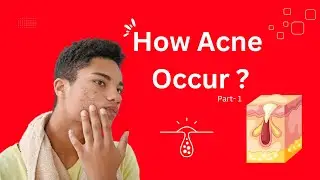 Understanding Facial Acne: Factors & Solutions | #Part1 #graceskinacademy