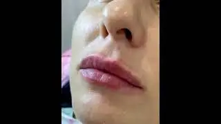 Контурная пластика губ (увеличение и коррекция формы)