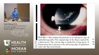 Epithelial Ingrowth [ARCHIVE]