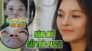 Hành trình tạm biệt mũi xấu, đón nhận mũi đẹp của Tuyết Nhi