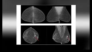 AI-assisted breast-cancer screening may reduce cases of patients called back for unnecessary testing