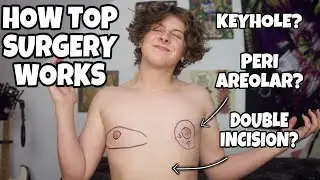 HOW TOP SURGERY WORKS (FTM TRANSGENDER) | NOAHFINNCE