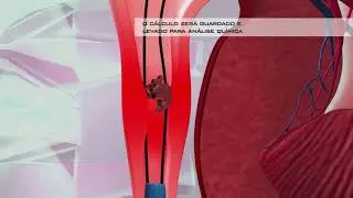 Tratamento de Cálculo Renal