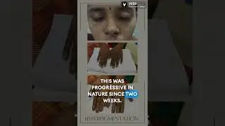 Chikungunya fever unique presentation