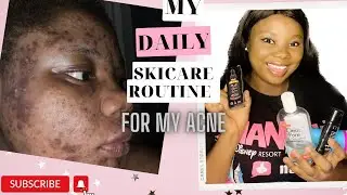My Daily Skincare Routine for My Acne With These Affordable Products