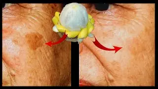 The Best Blemish-Removing Boiled Lemon Peel Recipe! Snow-White Skin with 100-Year-Old Recipes!