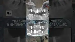 тотальная имплантация после пародонтита
