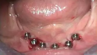 Dorothy -  Removed  Re-insert after 2 years