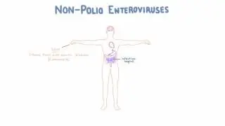 Non Polio Enteroviruses - Echovirus, Coxsackievirus, and Enterovirus