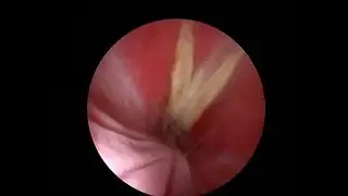 vaginal foreign body