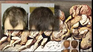 Hair Greed: RU58841 and Hair Identity.
