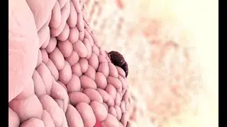 Opciones de Tratamiento Para el Cáncer de Cabeza y Cuello