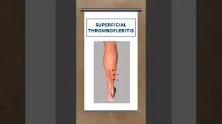 The 11 most common causes of calf pain