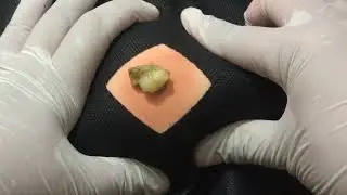 Treatment Of Blackhead Removal at Lam Dep Spa #039