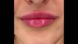 Inainte si dupa marirea buzelor