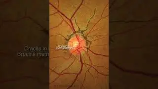 Angioid Streaks | #Shorts