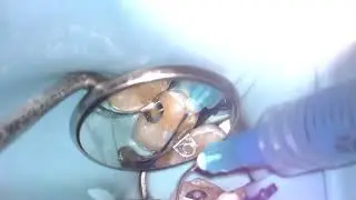 Composite Fillings 4,5