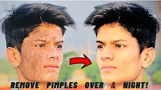 BEST MEDICINE,BEST REMEDY TO GET RID OF PIMPLES AND ACNE|HOW TO REMOVE PIMPLES AND ACNE|last episode