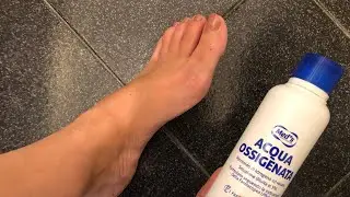 Metti l’acqua ossigenata sui piedi e guarda il risultato incredibile!Pedicure 