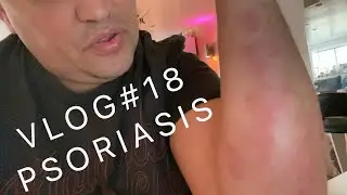 Vlog#18 - Naio Filming and Psoriasis Talk