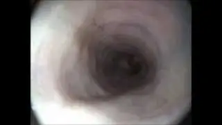 עותק של esophageal waves