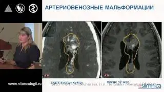 Лучевая терапия при лечении опухоли ЦНС. Лиепа З.