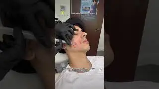 Subcision treatment for Acne Scars
