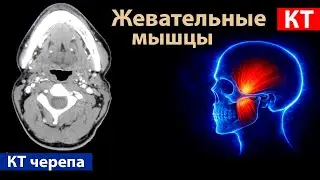 Лучевая анатомия жевательных мышц на КТ