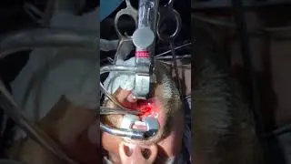 Peritonsiller abscess