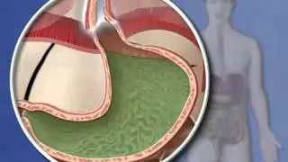 Factors that Contribute to GERD -- Hiatal Hernia