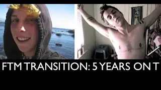FTM Transition: 5 Years on Testosterone Picture/Timeline