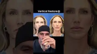 The Most Natural Facelift Transformation!