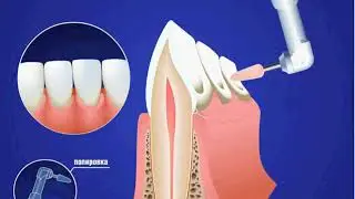 Что такое профессиональная гигиена полости рта?