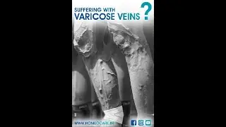 Homeopathy Treatment for Varicose Veins - Homeocare International