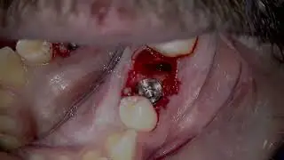 Dental Extraction & Post Implant Procedure