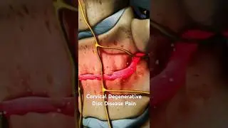 Cervical Degenerative Disc Disease Pain