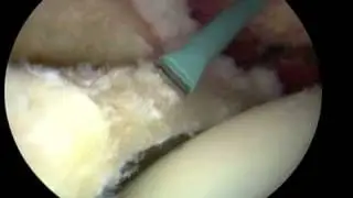 Hip Arthroscopy Final Preparation Labral Tissue
