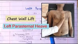 Clinical Sign Of Right Ventricular Hypertrophy ; Left Parasternal Heave. How To Palpate ?