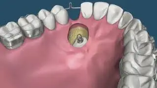 חשיפת ניב כלוא Orthodontic treatment with an impacted canine