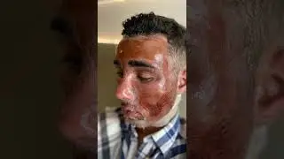Parte II - Peeling de fenol profundo. #peeling #peelingdefenol #cicatrizdeacne #acne #fenolprofundo