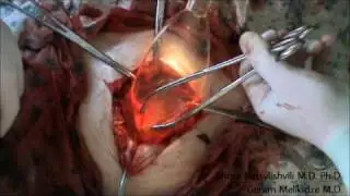 Lightpipe-based surgical instruments. Loop Excision of the Cervix. Hysterectomy