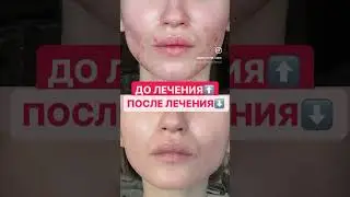 ДО и ПОСЛЕ лечения у доктора Юдиной М.М.
