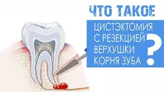 Цистэктомия с резекцией верхушки корня зуба