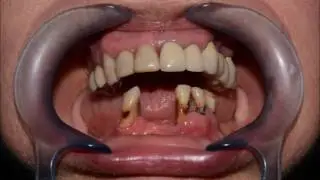 All-on-4® implantation. 4 cases. "Papadent" dental clinic.