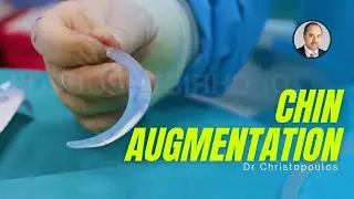 Chin augmentation with implant - Plastic Surgeon