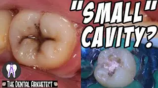 Restoring A Tooth Back To Its Original Shape #C17