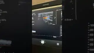 Звук УЗИ сосудов шеи 