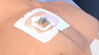 3M™ Tegaderm™ CHG (1664, 1665) Application and Removal Video: for Single Port