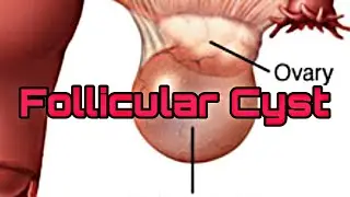 Follicular Cyst|Causes|Riskfactors|Symptoms|Diagnosis|Surgical Procedures